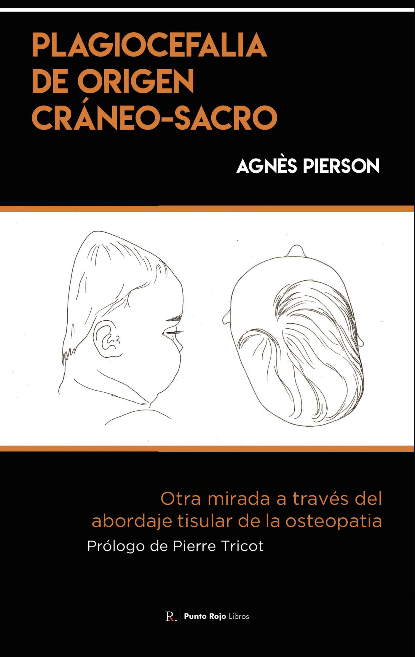 Portada de Plagiocefalia de origen cráneo-sacro