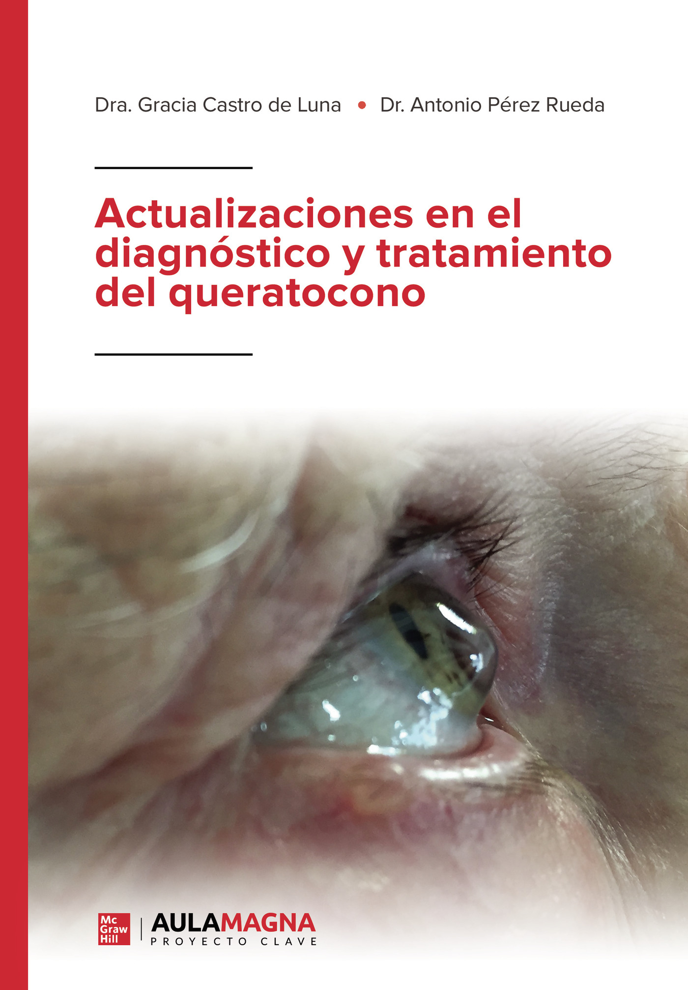 Portada de Actualizaciones en el diagnóstico y tratamiento del queratocono · Dra. Gracia Castro de Luna